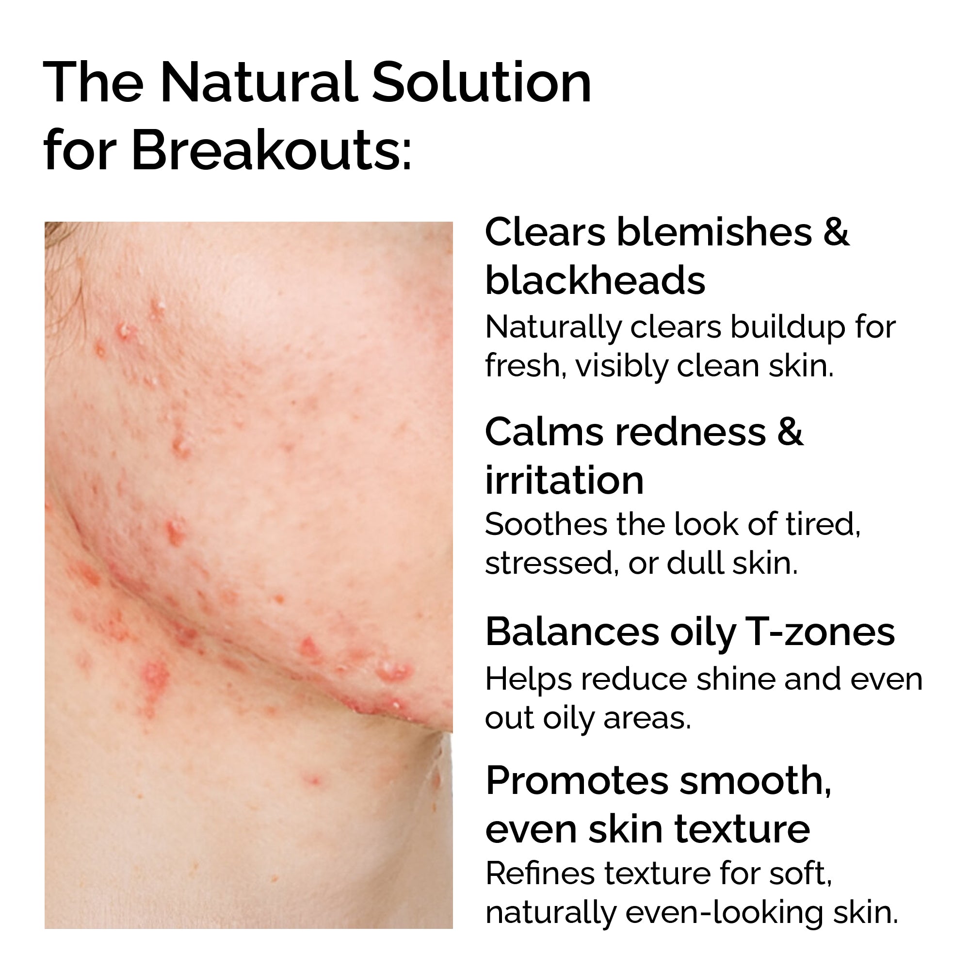 Clear Skin Blend – Essential Oils for Acne, Blemishes & Blackheads