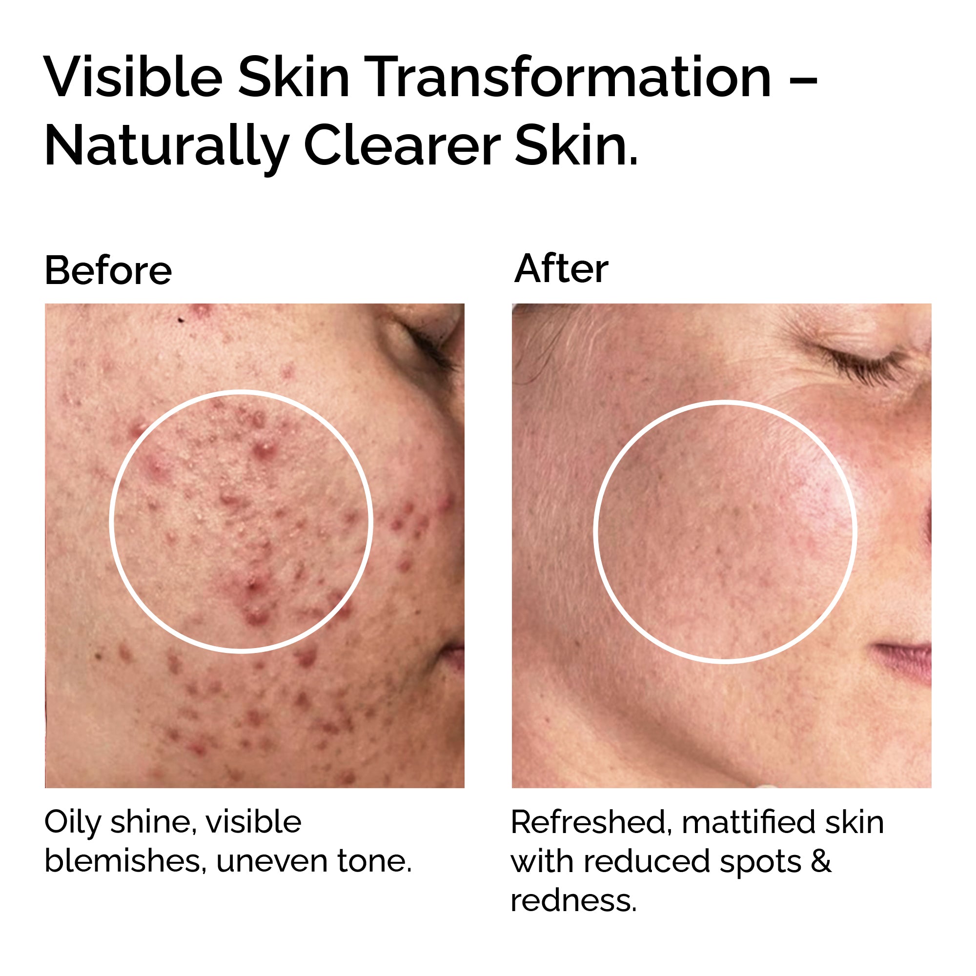 Clear Skin Blend – Essential Oils for Acne, Blemishes & Blackheads