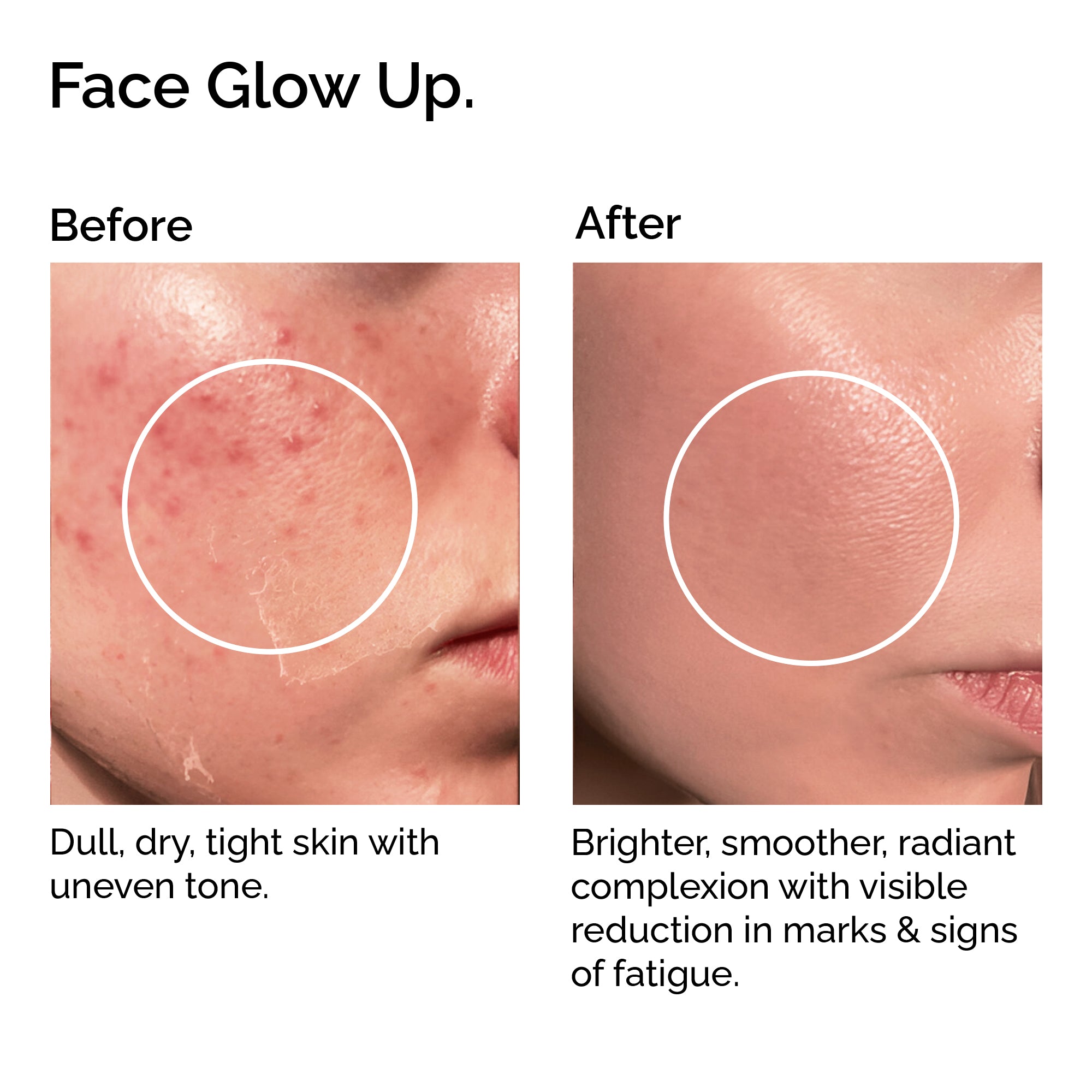 Before and after comparison of skin with acne and uneven texture, showing a smoother and brighter complexion.