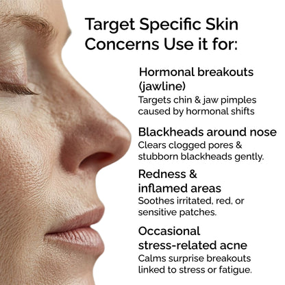 Clear Skin Blend – Essential Oils for Acne, Blemishes &amp; Blackheads